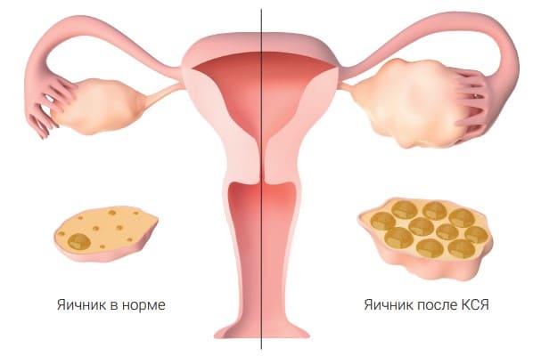 Стимуляция яичников. Яичники после стимуляции эко. Стимуляция яичников при эко.